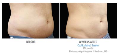Before-CoolSculpting