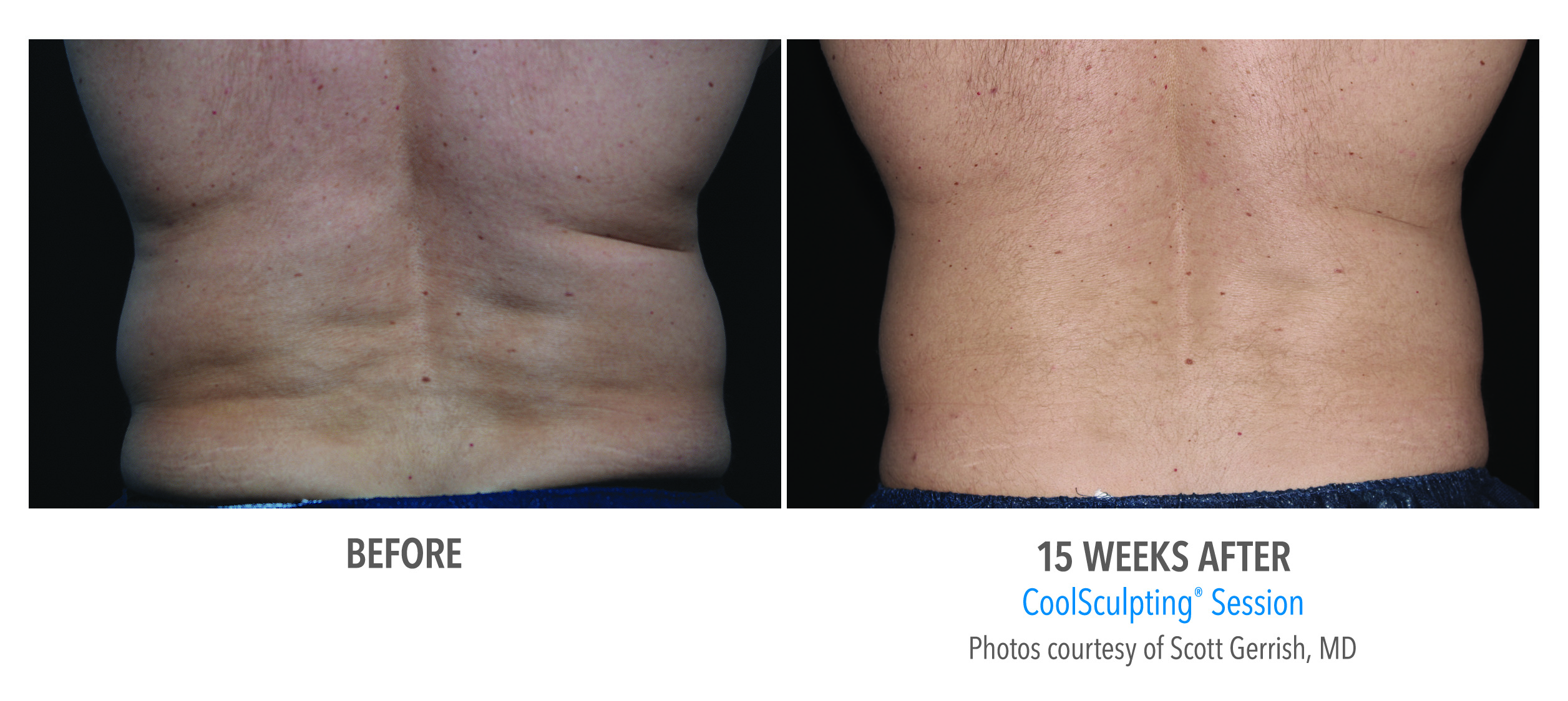 After-CoolSculpting
