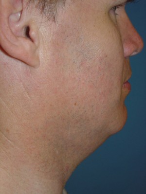 Before-Neck Liposuction