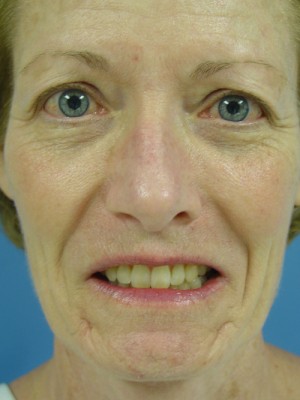 Before-Fat Transfer