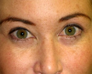 Before-Periorbital Filler