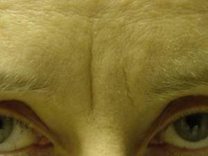 Before-Glabella
