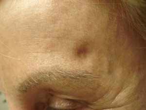 Before-Scar Fillers