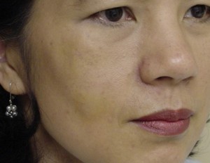 Before-Hemifacial Atrophy