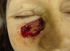 Before-Cheek Reconstruction