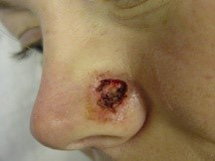 Before-Nose Reconstruction