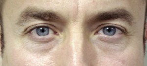 Before-Lower Blepharoplasty