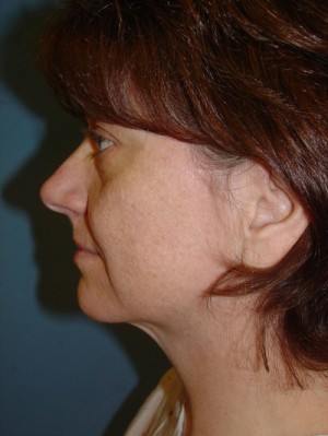 Before-Facelift