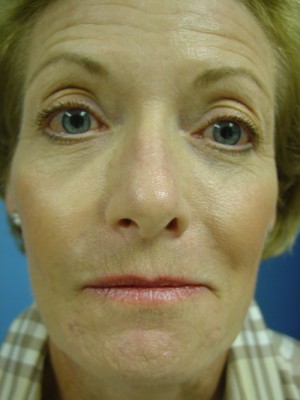 After-Fat Transfer
