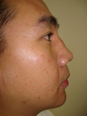 After-Nose and Chin
