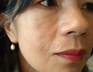 After-Hemifacial Atrophy