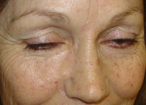 After-Cheek Reconstruction