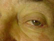 After-Eyelid Reconstruction