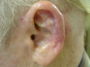 After-Ear Reconstruction