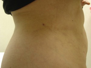 After-Liposuction