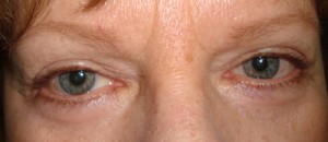 After-Upper & Lower Blepharoplasty