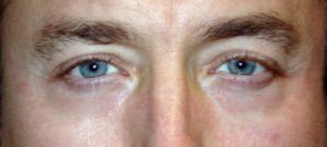 After-Lower Blepharoplasty