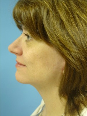 After-Facelift