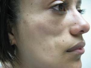 Before-Filler For Lupus