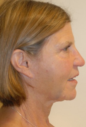 After-Liquid Facelift