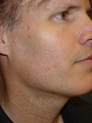 After-Neck Liposuction