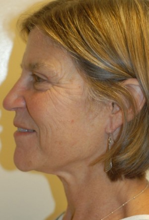 Before-Liquid Facelift