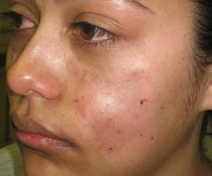 After-Filler For Lupus