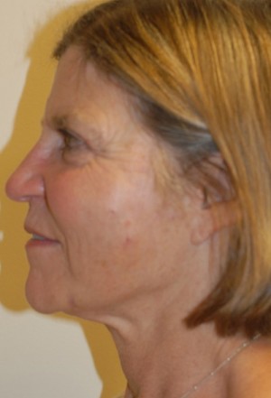 After-Liquid Facelift