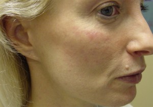 Before-Fat Transfer