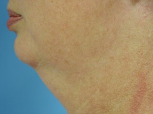 Before-Neck Liposuction