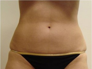 Before-Liposuction