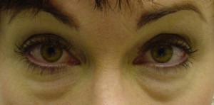 Before-Lower Blepharoplasty