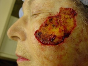Before-Cheek Reconstruction