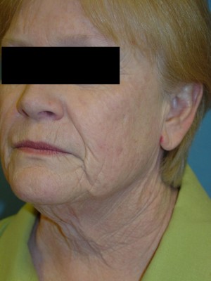 Before-Facelift