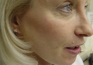 After-Fat Transfer