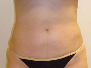 After-Liposuction