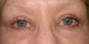 After-Upper & Lower Blepharoplasty