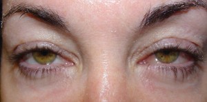 After-Lower Blepharoplasty
