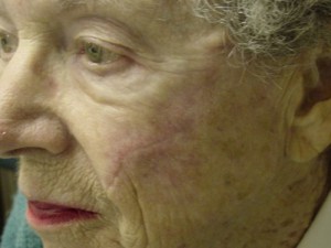 After-Cheek Reconstruction