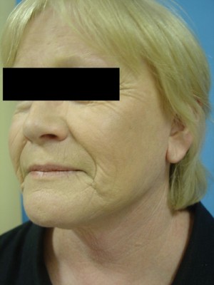 After-Facelift