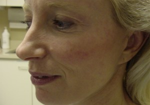 Before-Fat Transfer