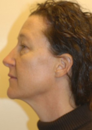 Before-Liquid Facelift