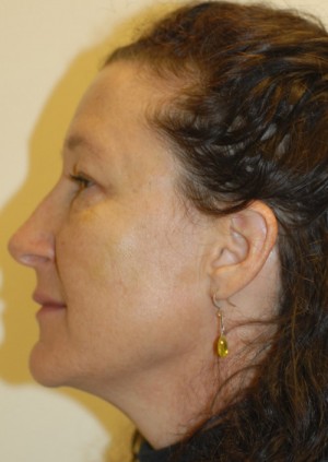 After-Liquid Facelift