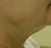 Before-Neck Liposuction