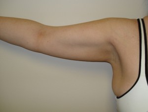 Before-Liposuction