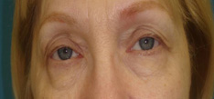 Before-Upper & Lower Blepharoplasty