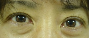 Before-Lower Blepharoplasty