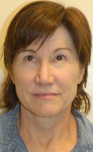 Before-Liquid Facelift