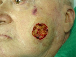 Before-Cheek Reconstruction