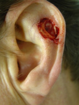 Before-Ear Reconstruction